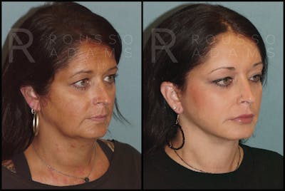 Facelift Before & After Gallery - Patient 141628423 - Image 1