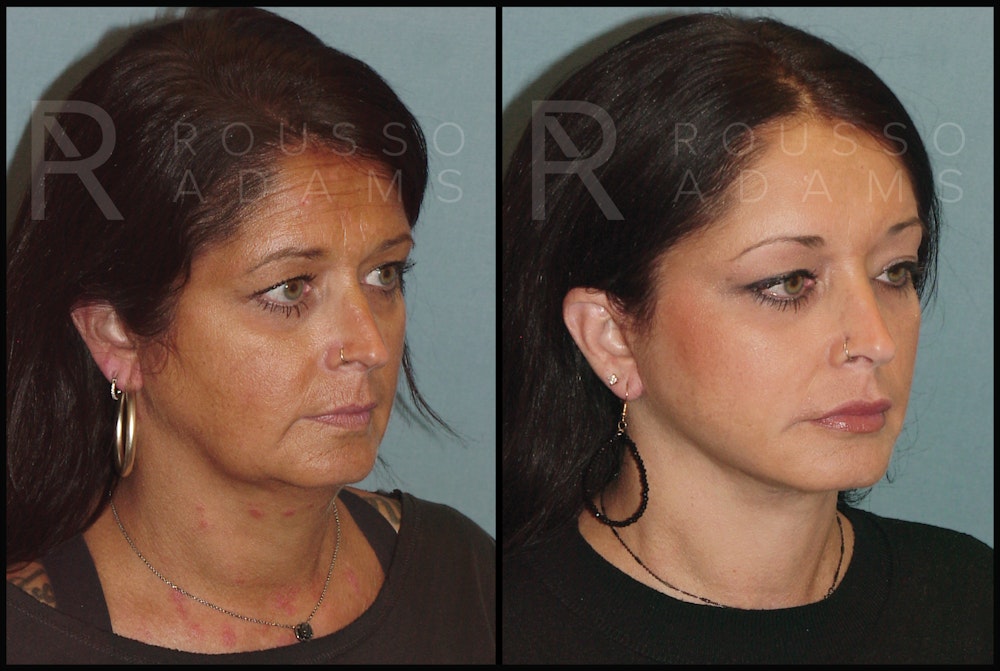 Facelift Before & After Gallery - Patient 141628423 - Image 1
