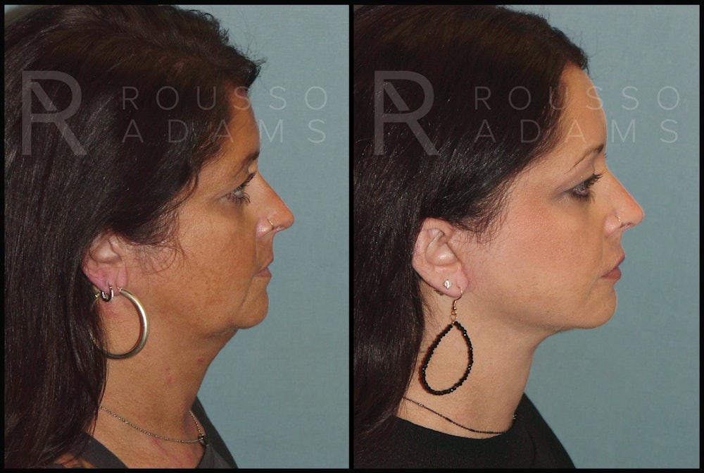 Facelift Before & After Gallery - Patient 141628423 - Image 2