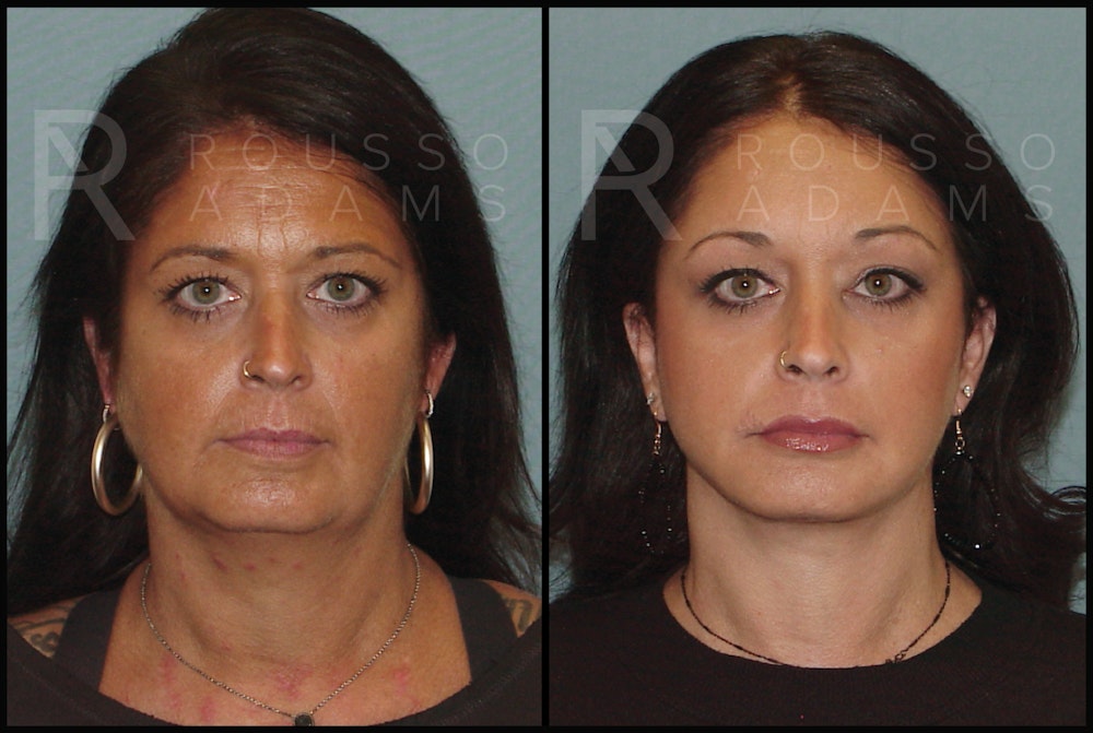 Facelift Before & After Gallery - Patient 141628423 - Image 3