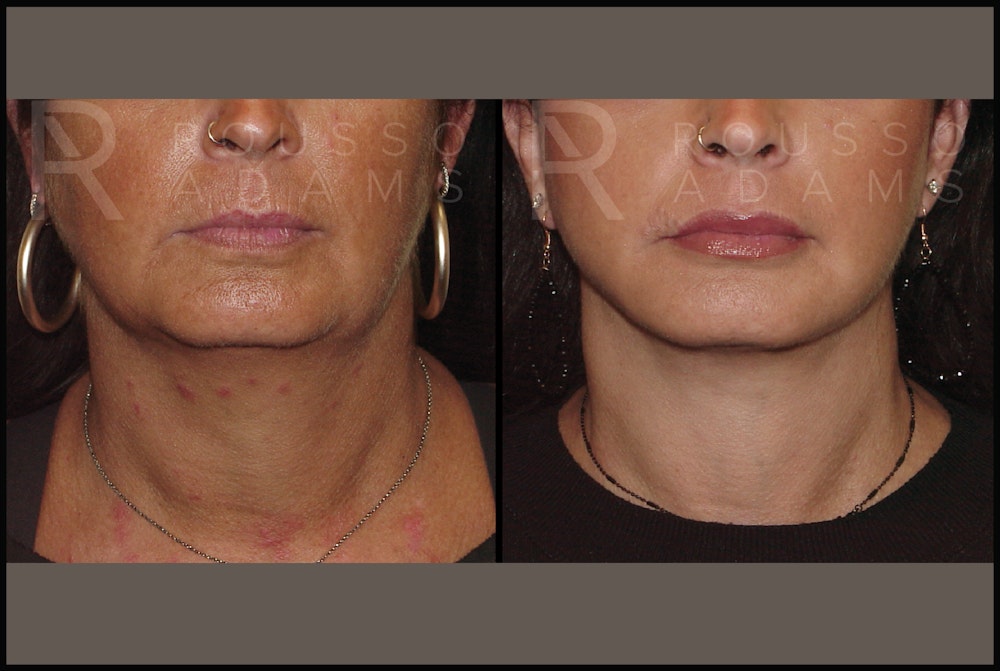 Facelift Before & After Gallery - Patient 141628423 - Image 4