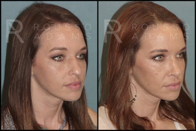 Rhinoplasty Before & After Gallery - Patient 144270846 - Image 1