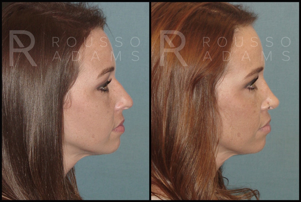 Rhinoplasty Before & After Gallery - Patient 144270846 - Image 2