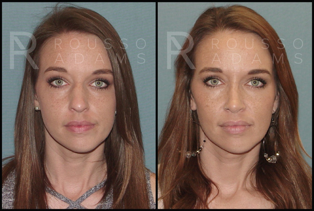 Rhinoplasty Before & After Gallery - Patient 144270846 - Image 3