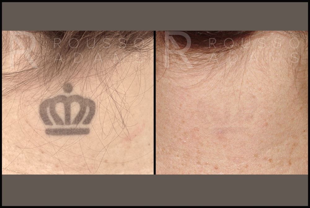 Tattoo Removal Before & After Gallery - Patient 144270857 - Image 1