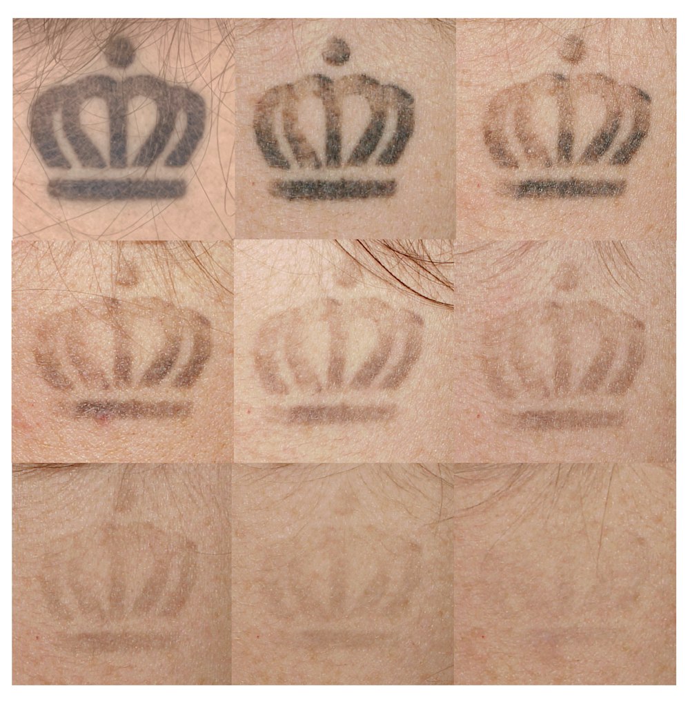Tattoo Removal Before & After Gallery - Patient 144270857 - Image 2