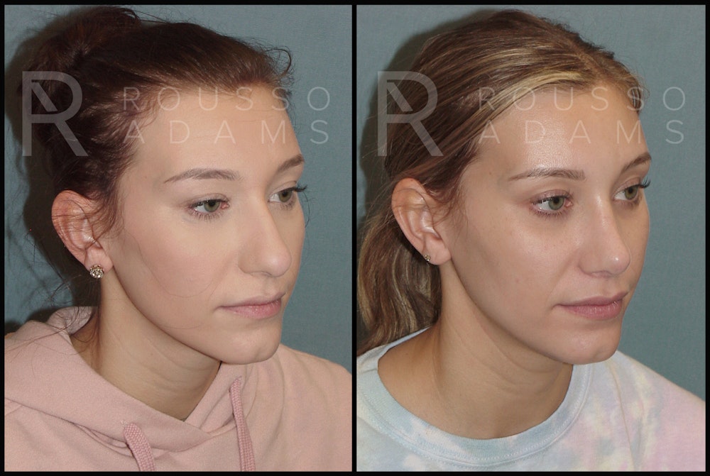 Rhinoplasty Before & After Gallery - Patient 144541184 - Image 1