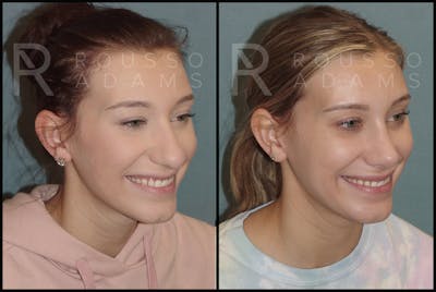 Rhinoplasty Before & After Gallery - Patient 144541184 - Image 2