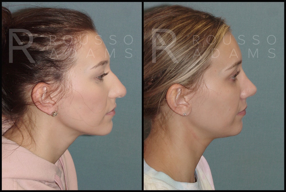 Rhinoplasty Before & After Gallery - Patient 144541184 - Image 3