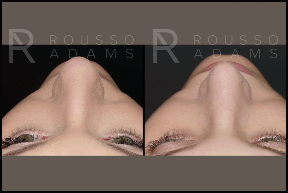 Rhinoplasty Before & After Gallery - Patient 144541184 - Image 5