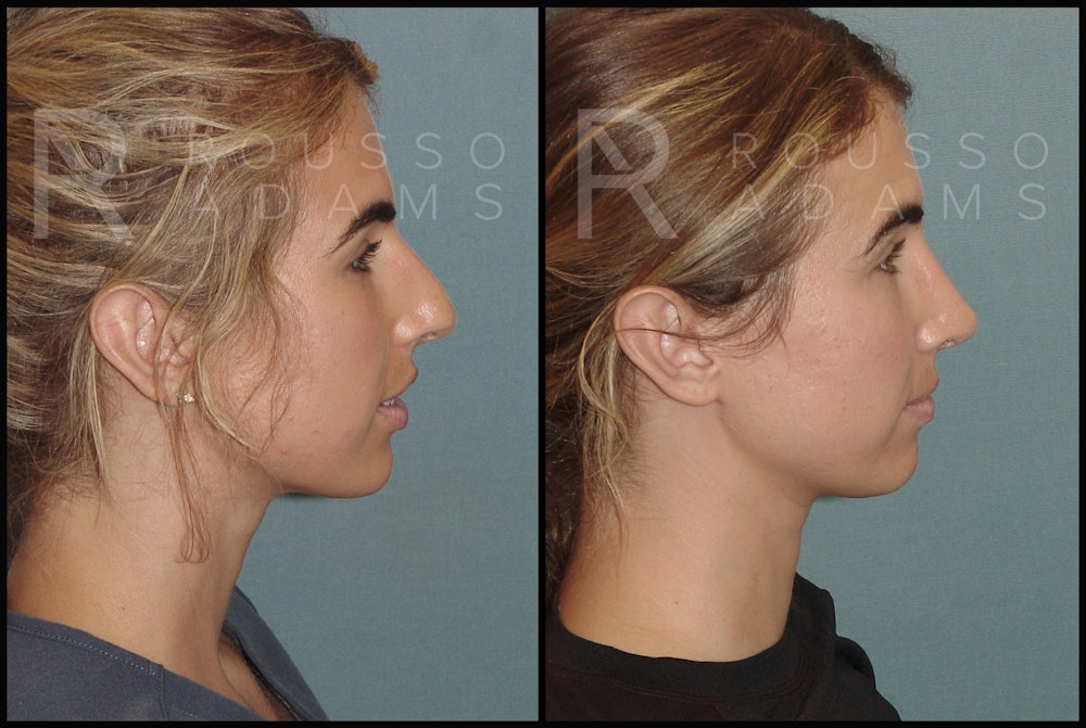 Rhinoplasty Before & After Gallery - Patient 144541189 - Image 3
