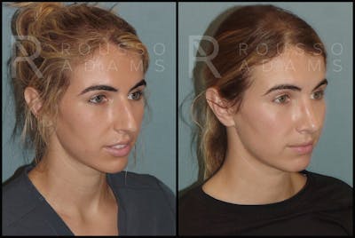 Rhinoplasty Before & After Gallery - Patient 144541189 - Image 1