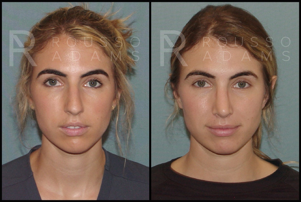 Rhinoplasty Before & After Gallery - Patient 144541189 - Image 4