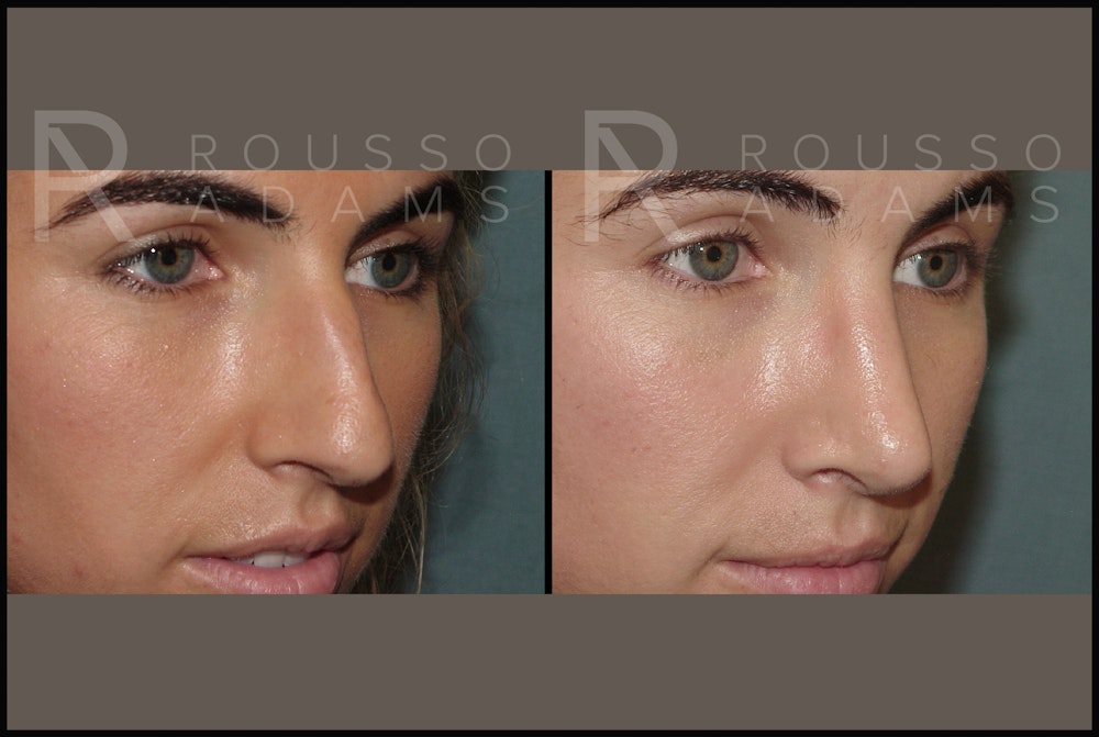 Rhinoplasty Before & After Gallery - Patient 144541189 - Image 5