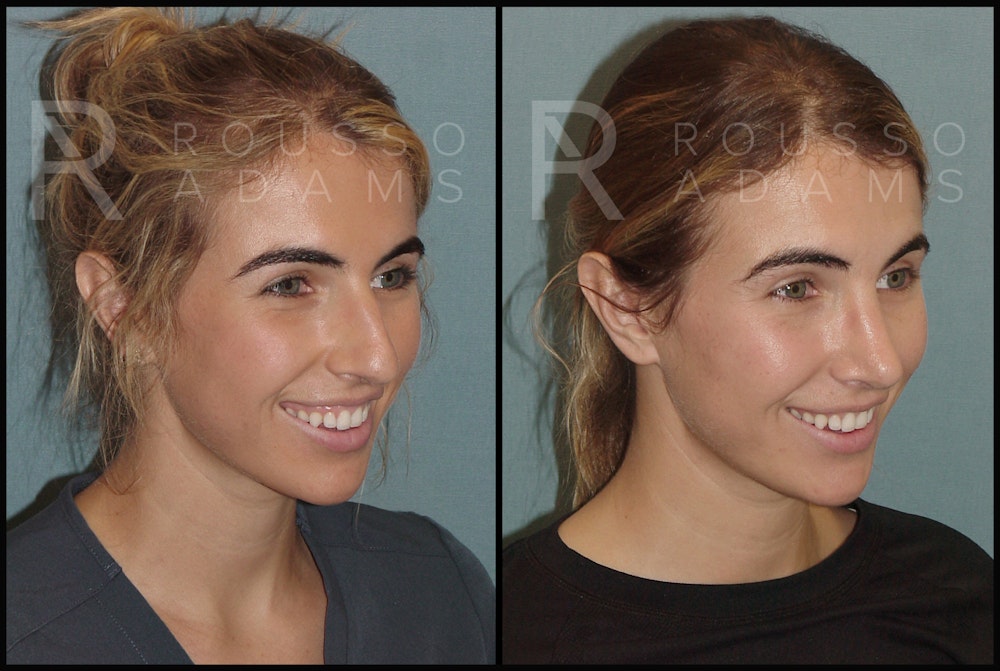 Rhinoplasty Before & After Gallery - Patient 144541189 - Image 2