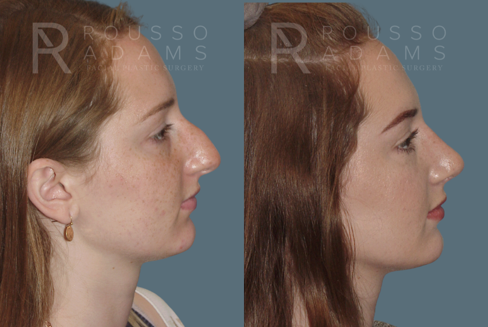 Rhinoplasty Before & After Gallery - Patient 146647185 - Image 1
