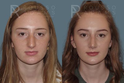 Rhinoplasty<span class=small>By Dr. Austin Adams</span> Before & After Gallery - Patient 146647185 - Image 2