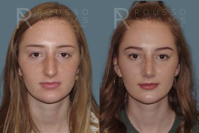 Rhinoplasty Before & After Gallery - Patient 146647185 - Image 2