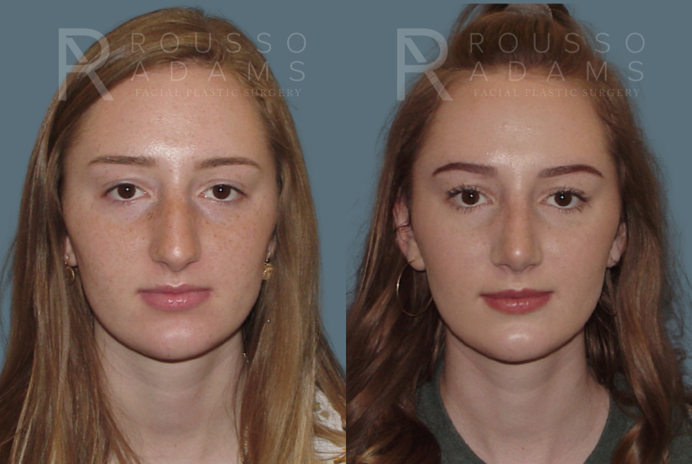 Rhinoplasty Before & After Gallery - Patient 146647185 - Image 2