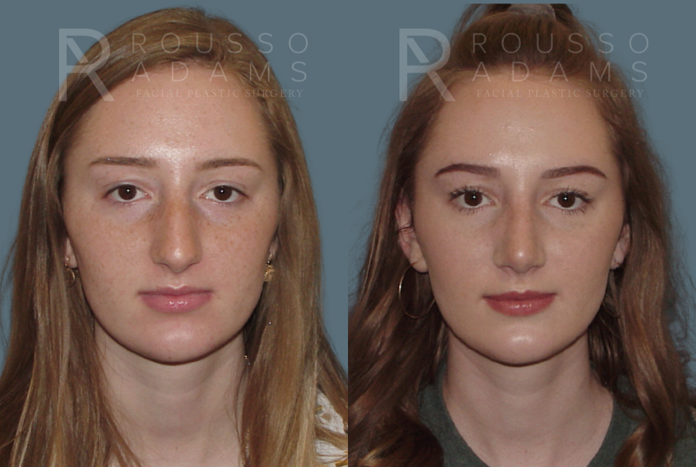 Rhinoplasty<span class=small>By Dr. Austin Adams</span> Before & After Gallery - Patient 146647185 - Image 2