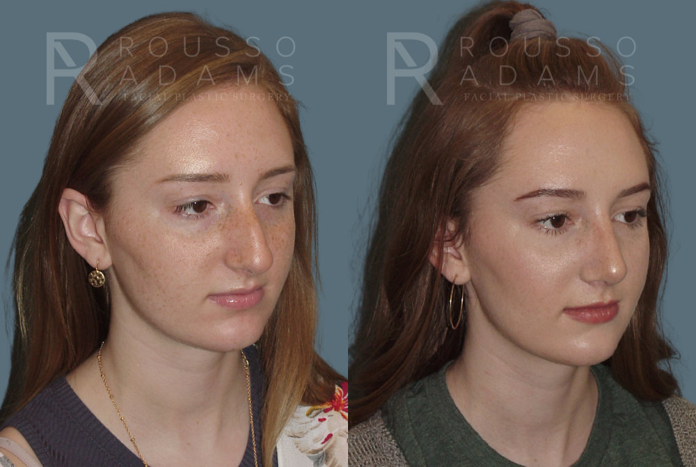 Rhinoplasty Before & After Gallery - Patient 146647185 - Image 3