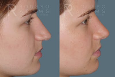 Rhinoplasty Before & After Gallery - Patient 146647193 - Image 1