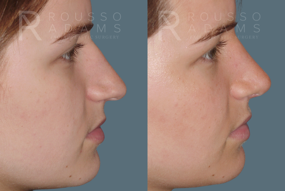 Rhinoplasty<span class=small>By Dr. Austin Adams</span> Before & After Gallery - Patient 146647193 - Image 1