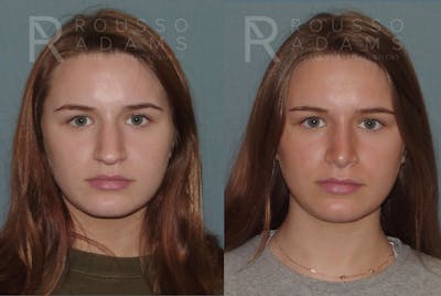 Rhinoplasty<span class=small>By Dr. Austin Adams</span> Before & After Gallery - Patient 146647193 - Image 2