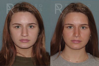 Rhinoplasty Before & After Gallery - Patient 146647193 - Image 2