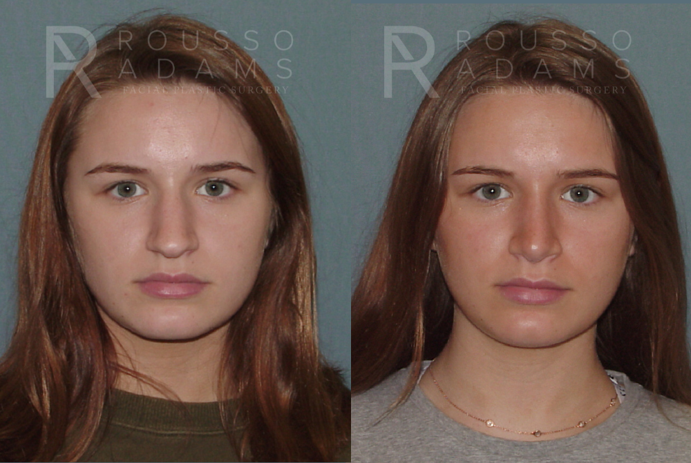 Rhinoplasty<span class=small>By Dr. Austin Adams</span> Before & After Gallery - Patient 146647193 - Image 2