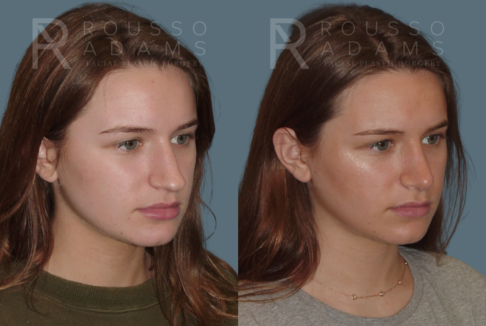 Rhinoplasty<span class=small>By Dr. Austin Adams</span> Before & After Gallery - Patient 146647193 - Image 3
