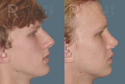 Rhinoplasty<span class=small>By Dr. Austin Adams</span> Before & After Gallery - Patient 146647186 - Image 1