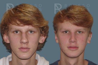 Rhinoplasty Before & After Gallery - Patient 146647186 - Image 2