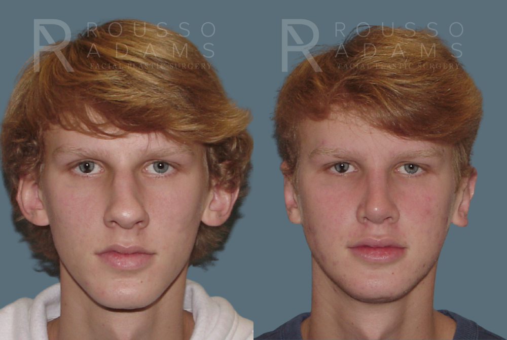 Rhinoplasty<span class=small>By Dr. Austin Adams</span> Before & After Gallery - Patient 146647186 - Image 2