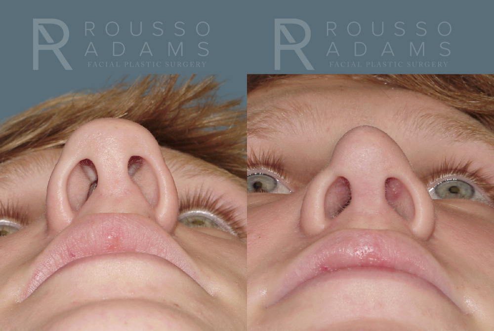 Rhinoplasty Before & After Gallery - Patient 146647186 - Image 3