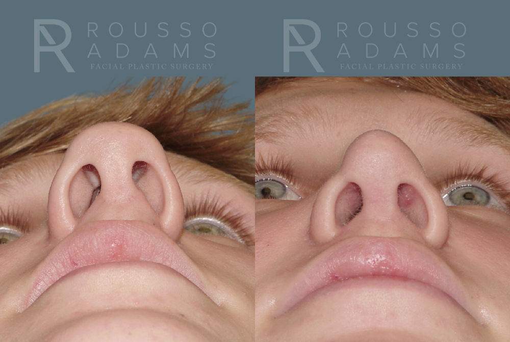 Rhinoplasty<span class=small>By Dr. Austin Adams</span> Before & After Gallery - Patient 146647186 - Image 3