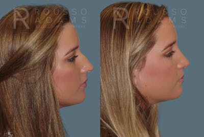 Rhinoplasty Before & After Gallery - Patient 146647187 - Image 1