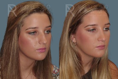 Rhinoplasty<span class=small>By Dr. Austin Adams</span> Before & After Gallery - Patient 146647187 - Image 2