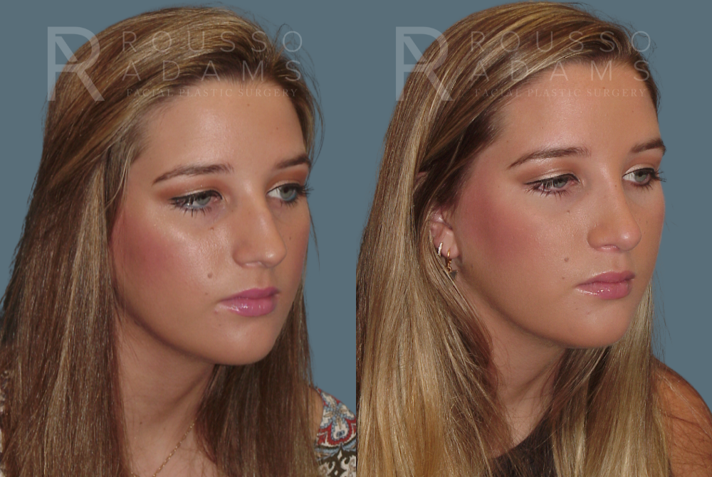Rhinoplasty Before & After Gallery - Patient 146647187 - Image 2