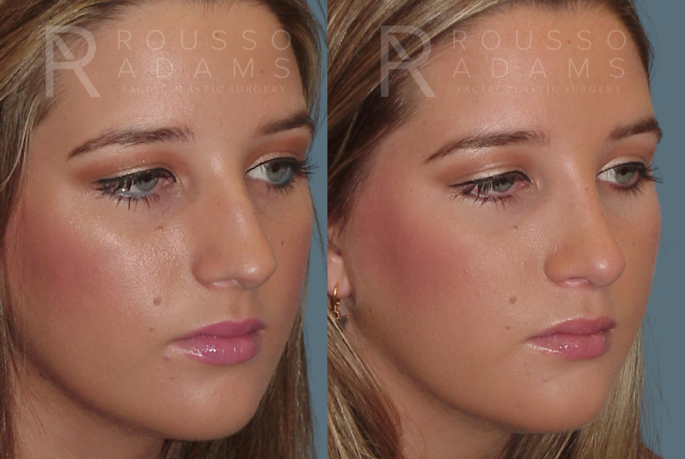 Rhinoplasty Before & After Gallery - Patient 146647187 - Image 3