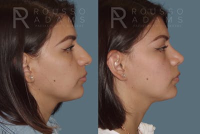 Rhinoplasty Before & After Gallery - Patient 146647188 - Image 1