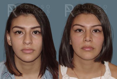 Rhinoplasty<span class=small>By Dr. Austin Adams</span> Before & After Gallery - Patient 146647188 - Image 2