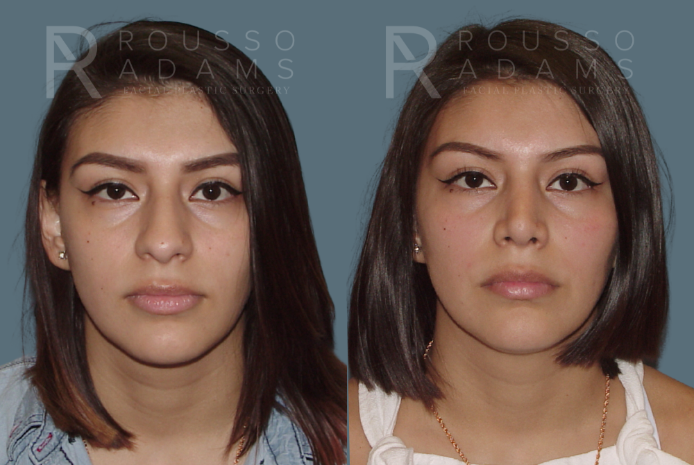 Rhinoplasty Before & After Gallery - Patient 146647188 - Image 2