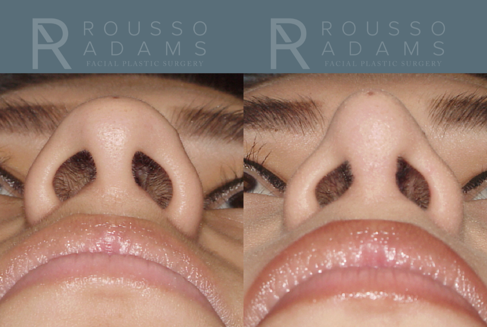 Rhinoplasty<span class=small>By Dr. Austin Adams</span> Before & After Gallery - Patient 146647188 - Image 3