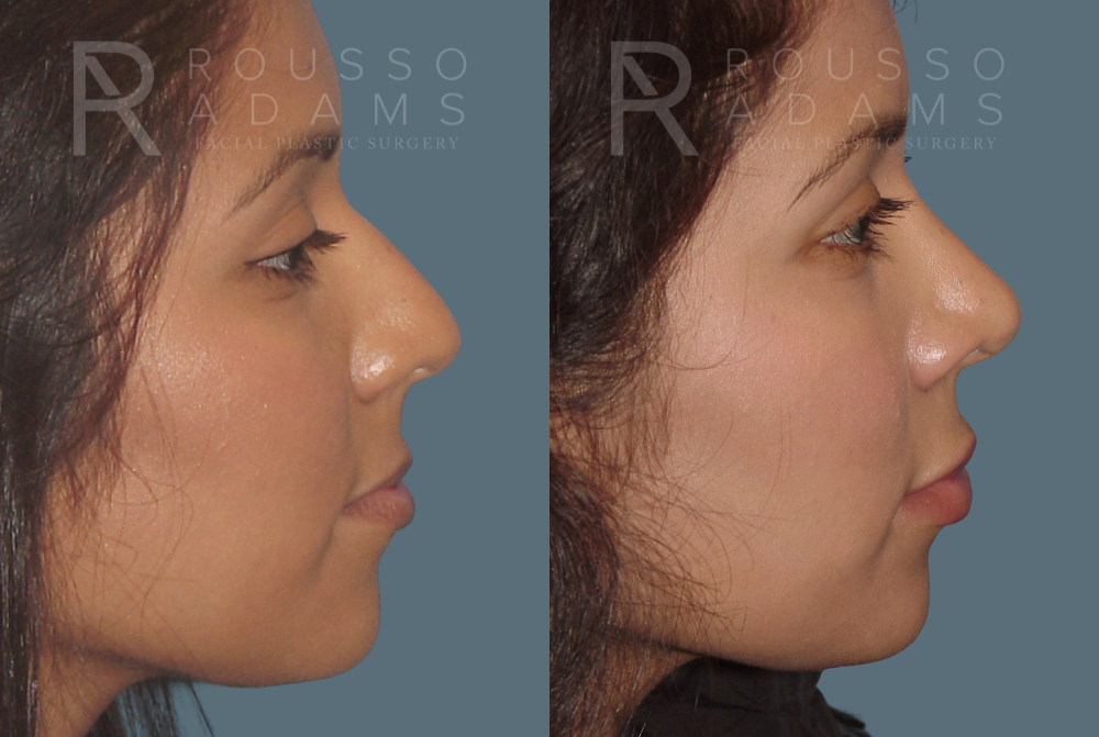 Rhinoplasty Before & After Gallery - Patient 146647189 - Image 1