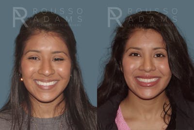 Rhinoplasty<span class=small>By Dr. Austin Adams</span> Before & After Gallery - Patient 146647189 - Image 2