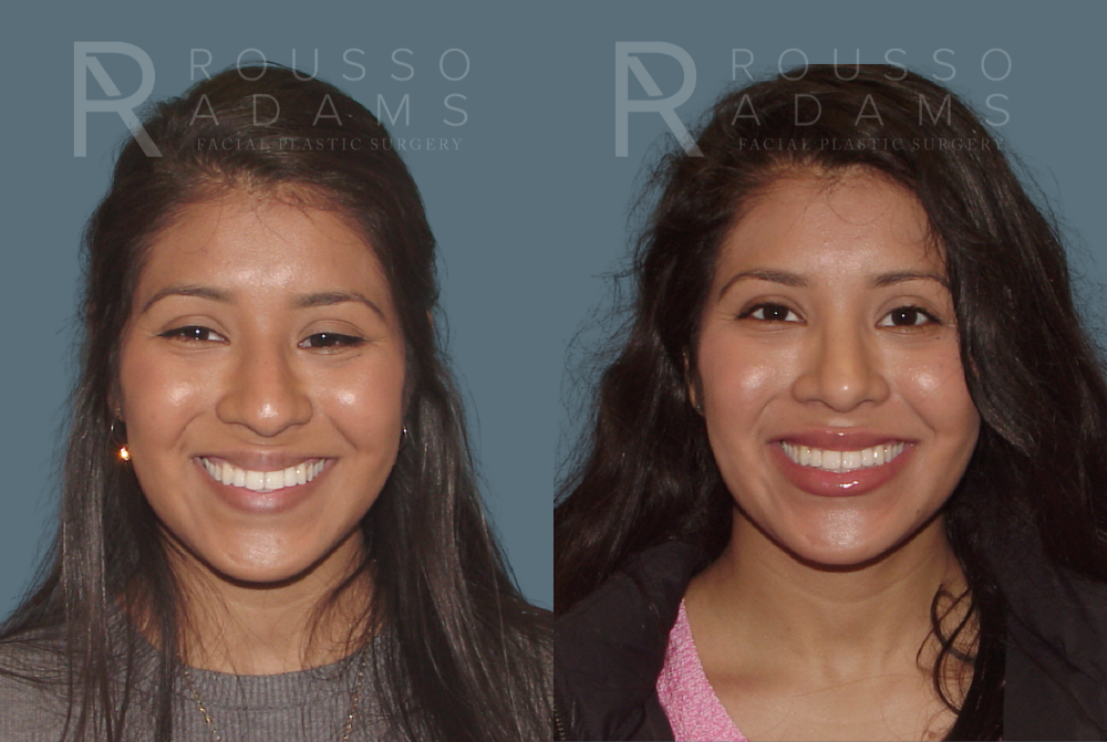 Rhinoplasty Before & After Gallery - Patient 146647189 - Image 2