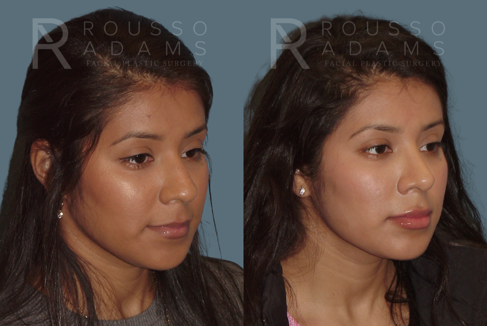 Rhinoplasty Before & After Gallery - Patient 146647189 - Image 3