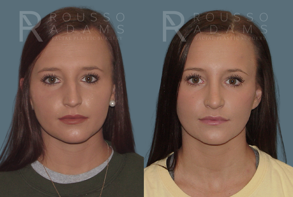 Rhinoplasty Before & After Gallery - Patient 146647190 - Image 3