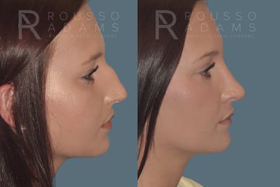 Rhinoplasty<span class=small>By Dr. Austin Adams</span> Before & After Gallery - Patient 146647190 - Image 1